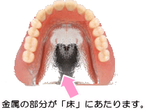 金属床義歯